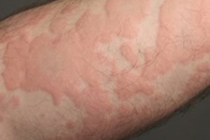 Herbs for Natural Treatment of Urticaria (Hives)