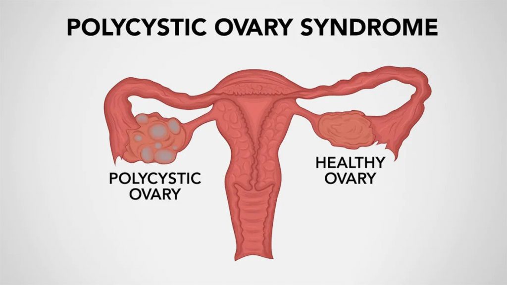 Polycystic Ovarian Syndrome Treatment