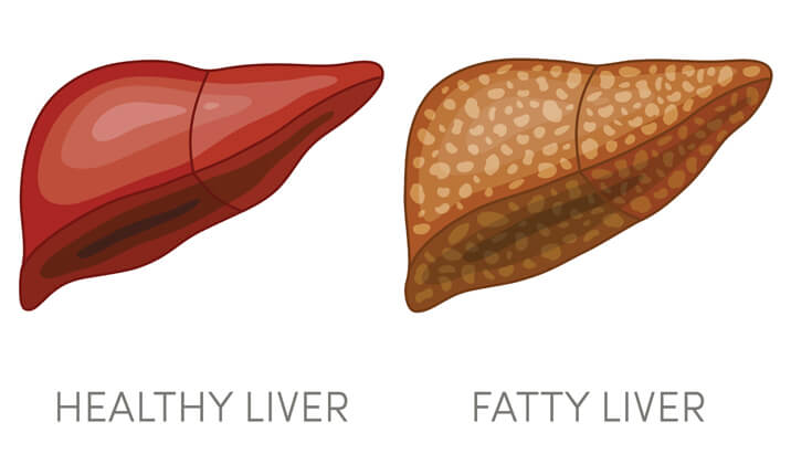 Ayurvedic Treatment of Fatty Liver