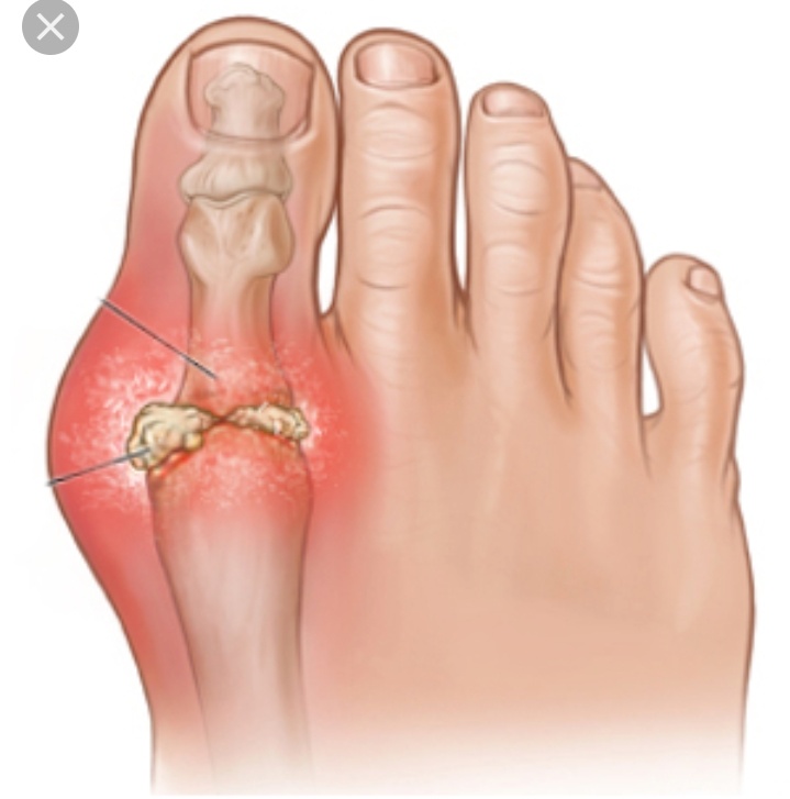 Home Remedies for Gout