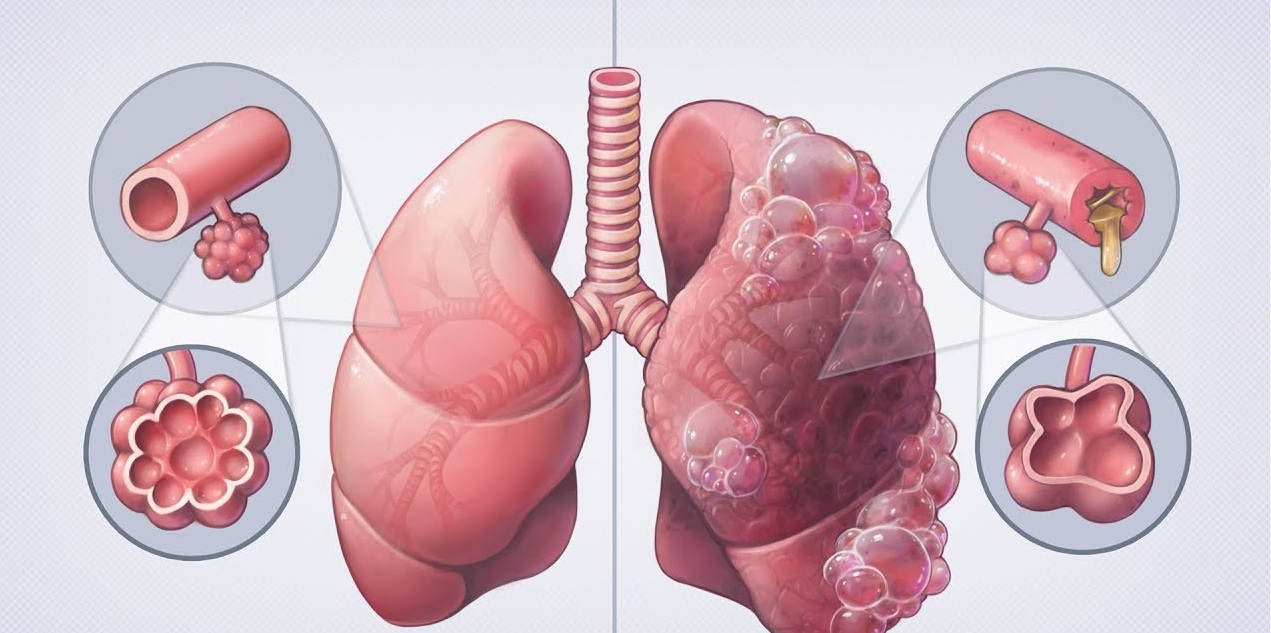 Ayurvedic Treatment for Bronchitis