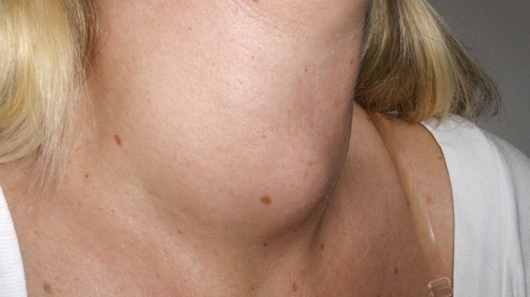 What Is Thyroid And Goiter