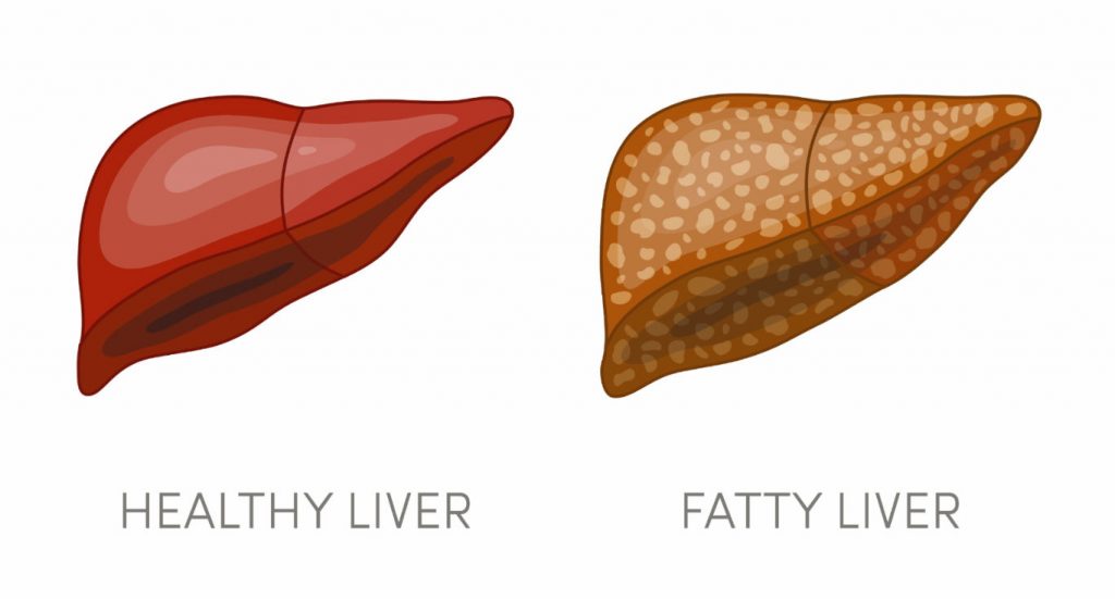 Fatty Liver Home Remedies, Symptoms, Causes & Treatment | Chandigarh ...