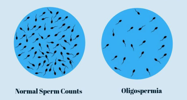 Oligospermia (Shukrakshya) | Chandigarh Ayurved & Panchakarma Centre