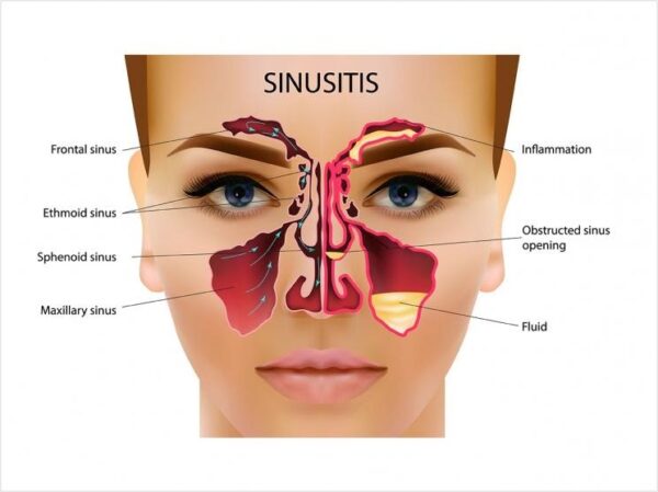 SINUSITIS | Chandigarh Ayurved & Panchakarma Centre