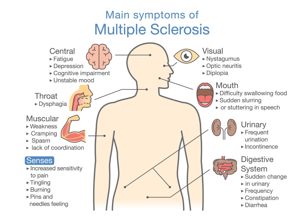 MULTIPLE SCLEROSIS TREATMENT ACCORDING TO AYURVEDA