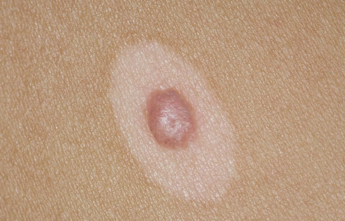 HALO NEVUS