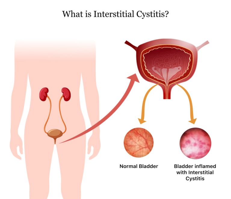 best-herbal-remedies-for-interstitial-cystitis