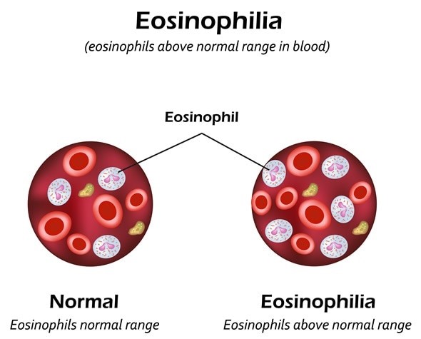 How To Reduce Eosinophil Count In Ayurveda