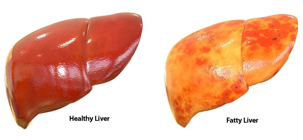 what foods causes fatty liver?