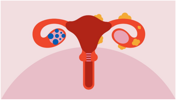 Understanding The Differences Between Pcos and Endometriosis ...