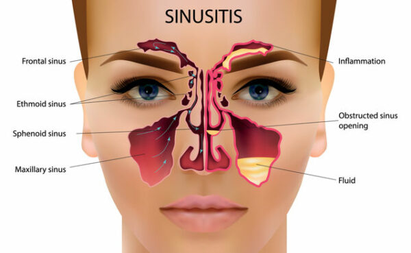 SINUSITIS – WEEKLY DIET PLAN | Chandigarh Ayurved & Panchakarma Centre