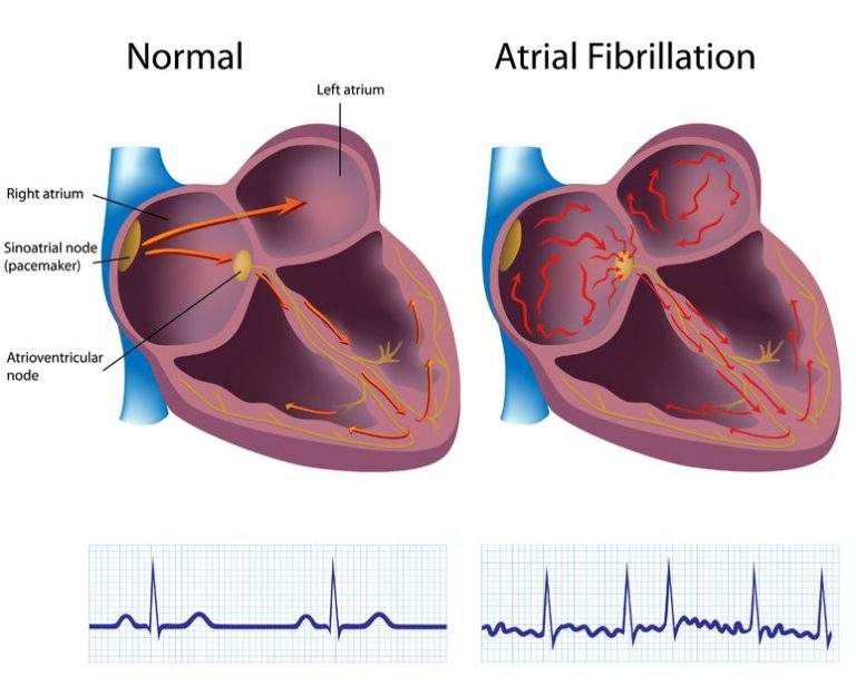 HOW TO CURE ATRIAL FIBRILLATION NATURALLY? | Chandigarh Ayurved ...