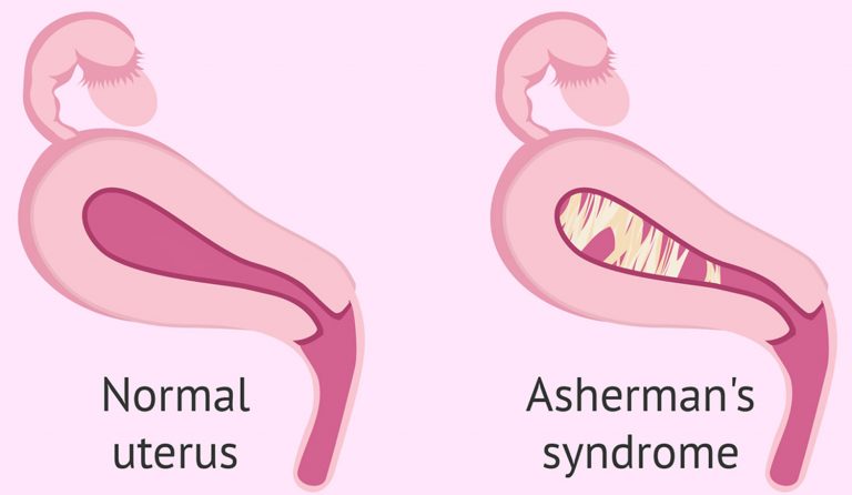 Asherman’s Syndrome 