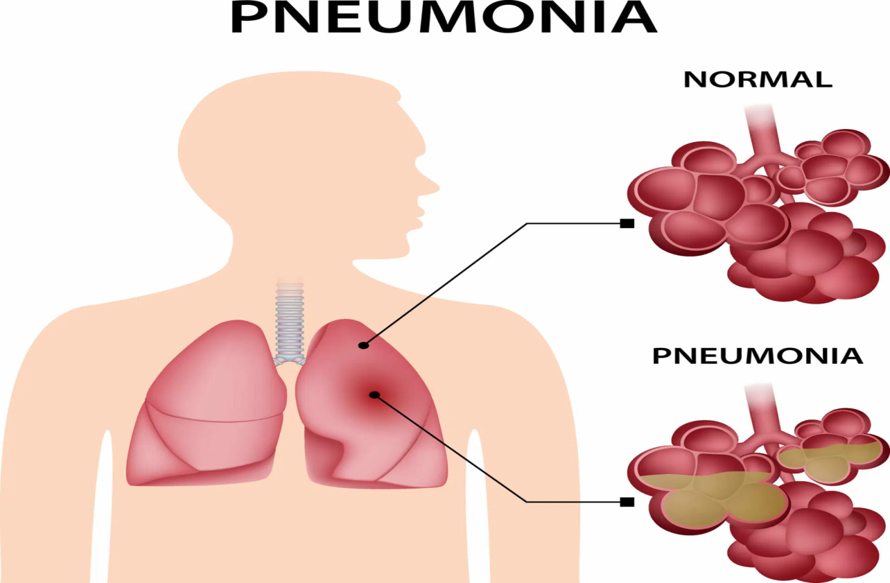 Top Herbal Remedies for Influenza and Pneumonia | Chandigarh Ayurved ...