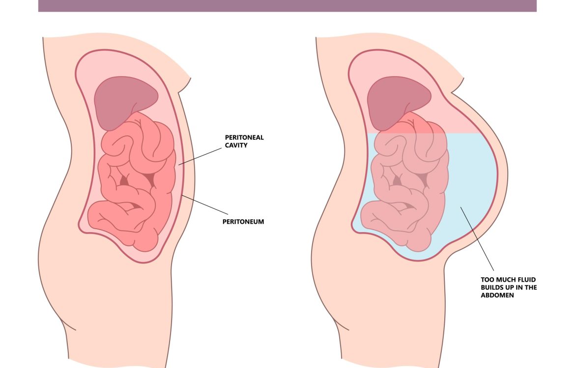 Ascites