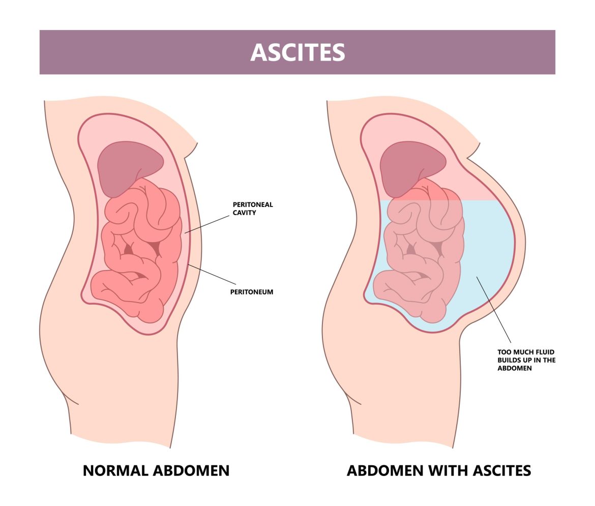 Ascites