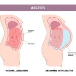 Ascites